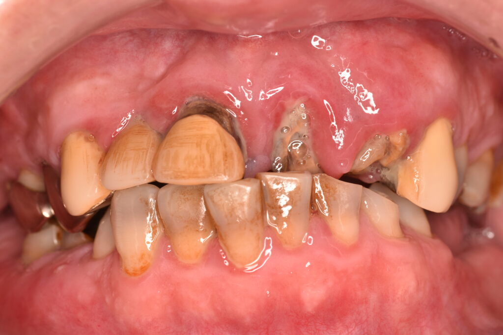 歯がボロボロ|佐世保の歯医者が解説